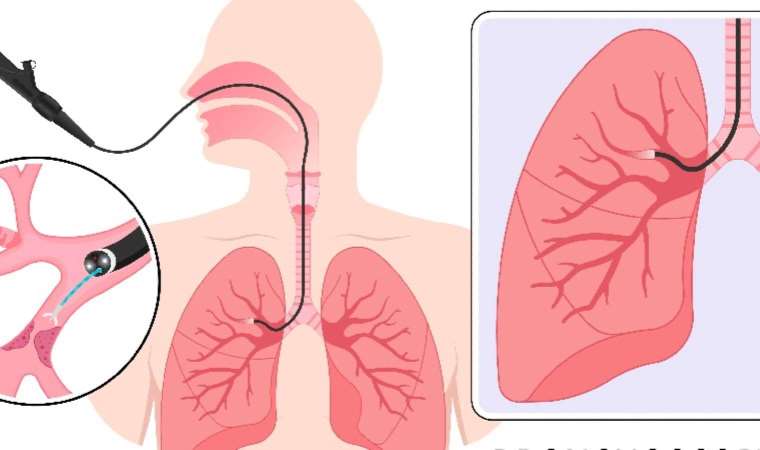 Otomatik iğne deride özgürce hareket edebiliyor! Aktif bir akciğerde test edildi