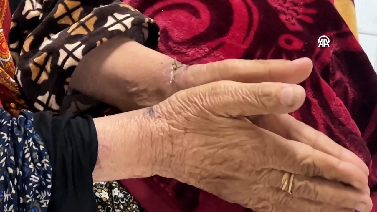 İsrailin elinden kurtulan yaşlı kadın vücudunda işkence izleriyle hastaneye sığındı